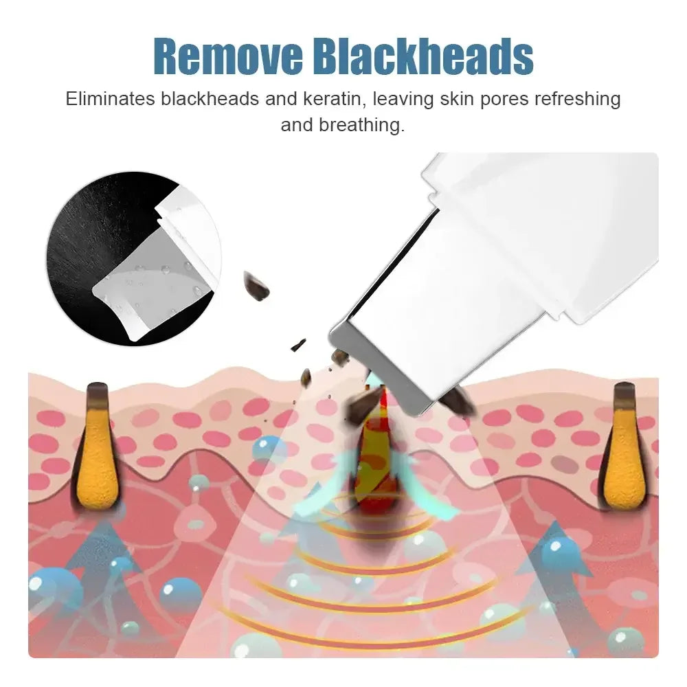 Ultrasonic Skin Scrubber Spatula – Blackhead Removal, Deep Pore Cleansing & Exfoliating Tool